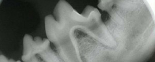 Dental Decay x ray